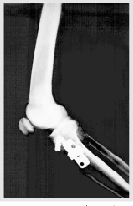 Figure 1 From Valgus Osteotomy Of The Tibia With A Puddu Plate Combined
