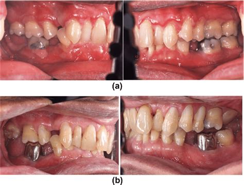 A Male Patient With Oral Mucous Membrane Pemphigoid A Ulceration Of