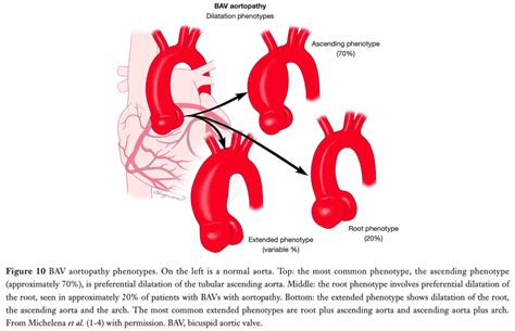 Dilatação Da Aorta Ascendente