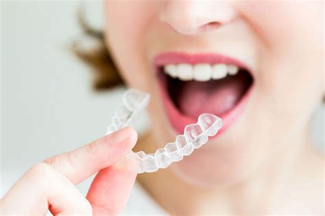 Invisalign For Kids And Adults In Chatsworth Ca Topanga Dental