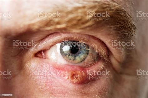 Mans Infected Eye With A Chalazion A Blocked Sebaceous Glad On The