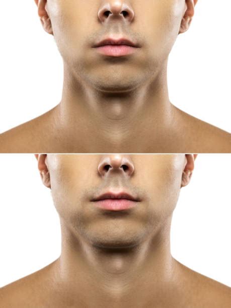 Protruding Jaw Stock Photos Pictures And Royalty Free Images Istock