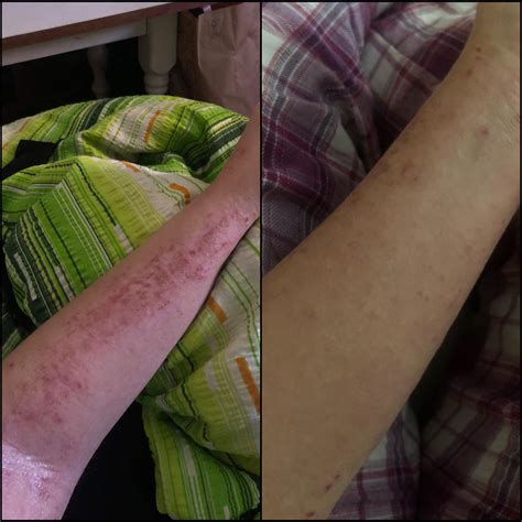 Update On My Severe Eczema Dermatitis Atopica Third Day On Elocom
