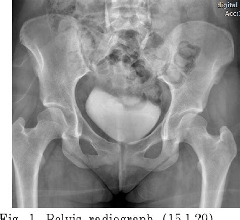 Figure 1 From Case Report Of A Pelvic Pain Patient With Pubic Fracture