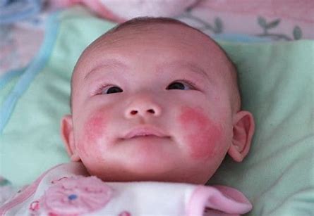Image result for neonatal lupus