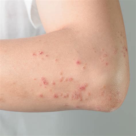 0 Result Images Of Different Types Of Skin Rashes PNG Image Collection