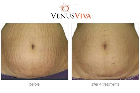 Venus Viva Procedure Beautiful Skin Treatment On Maui