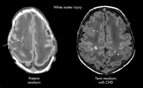 Neurology Of Congenital Heart Disease Insight From Brain Imaging Adc
