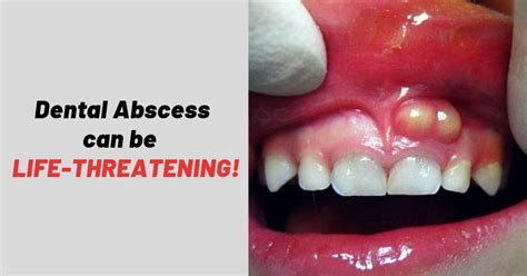 Periodontal Abscess Vs Periapical Abscess