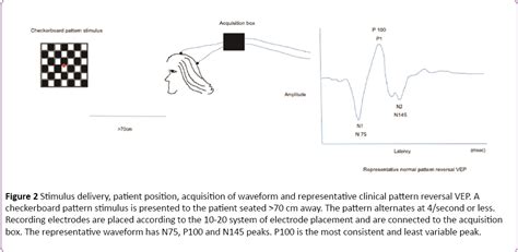 Intraoperative Visual Evoked Potentials There Is More To It Than Meets