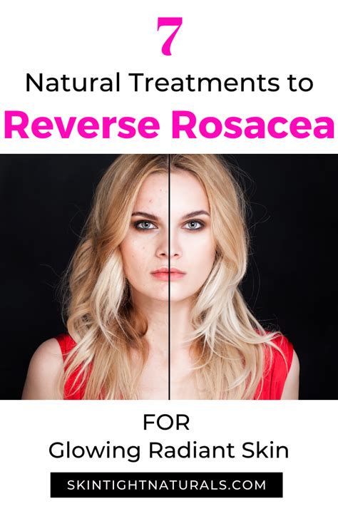 How To Get Rid Of Rosacea Skin Tight Naturals In 2021 Glowing