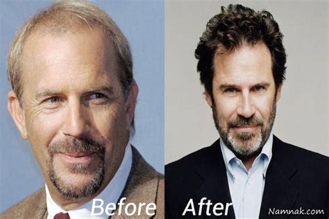 کاشت مو عکس قبل و بعد افراد مشهور با پیوند موی پرپشت