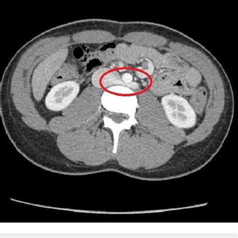 Axial Contrast Enhancement Ct Of The Abdomen At The Level Of The Lrv