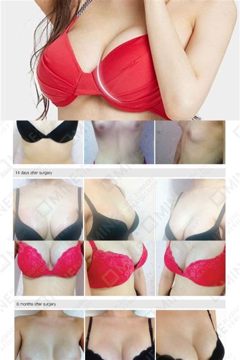 Pin On Korean Breast Augmentation