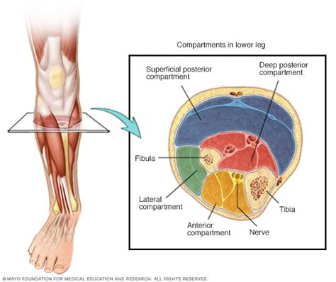 Chronic Exertional Compartment Syndrome Symptoms And Causes Mayo Clinic