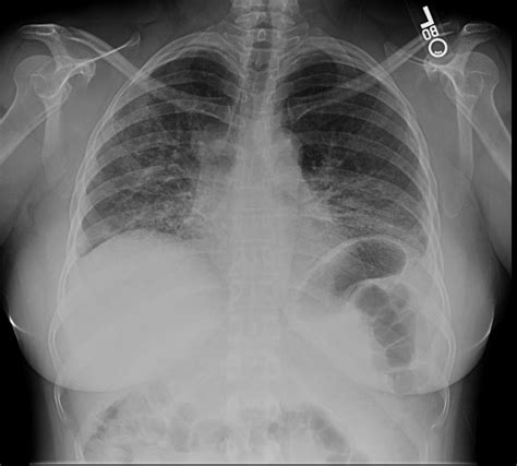 Idiopathic Pulmonary Fibrosis Image