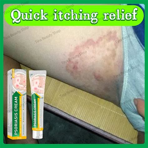 Ubat Gatal Gatal Kulit Eczema Treatment Cream Antibacterial Psoriasis