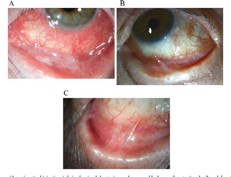 Dupilumab Associated Cicatrizing Ocular Disease Semantic Scholar