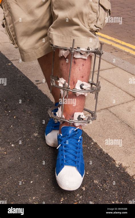 A Man With His Leg In A Steel Brace In The Uk Stock Photo Alamy