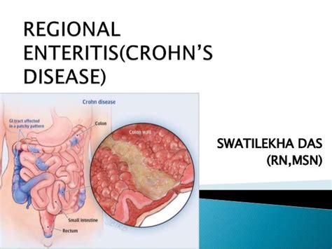 Crohns Disease With Nursing Management