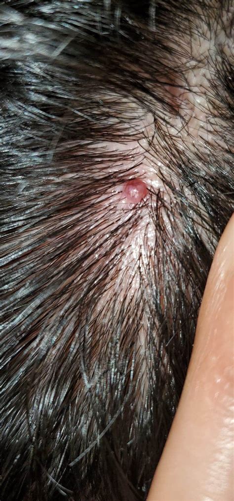 What Is This On My Scalp Its Hard I Tried Poking It And Goo Comes