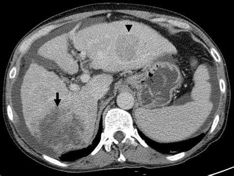 Abdominal Ct Scan And Liver Mri Findings Of Right Arrows And Left