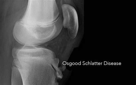 Osgood Schlatter Adolescent Knee Pain Podiatrist Cottesloe Perth