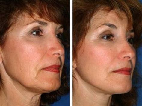 Thread Face Lift Treatment In Our London Uk Clinic Linia Skin