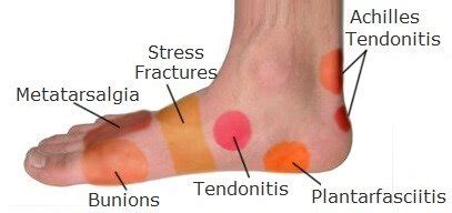 If you feel pain on the top of your foot as you're running, one of the causes can be extensor tendonitis. Sharp pain in arch of foot when resting > NISHIOHMIYA-GOLF.COM