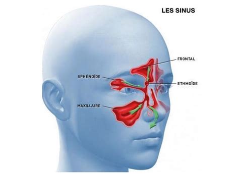 Sinusites Chroniques Dr Lasfargue