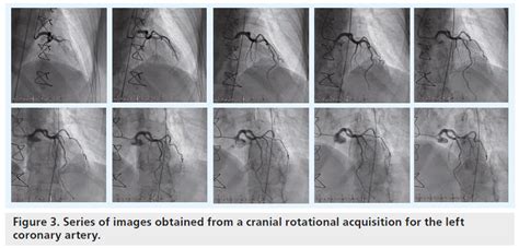 3d Fluoroscopy Based Imaging In The Cardiovascular Catheterizatio