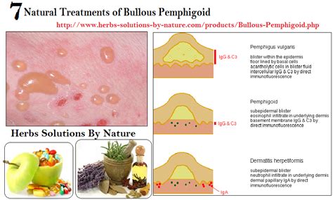 7 Natural Treatments Of Bullous Pemphigoid Herbs Solutions By Nature Blog
