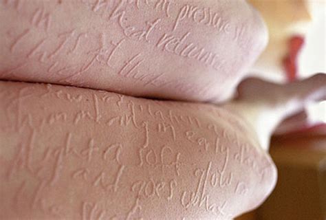 Dermatographism Dermatographic Urticaria Skin Writing Causes And