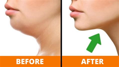 How To Get Rid Of Chin Fat And Unleash An Aesthetic Jawline