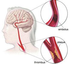 Acute neurologic injury caused by ischemia or hemorrhage. 320 Exam 1 flashcards | Quizlet