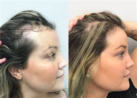 Haartransplantation Bei Frauen In Der T Rkei Preise