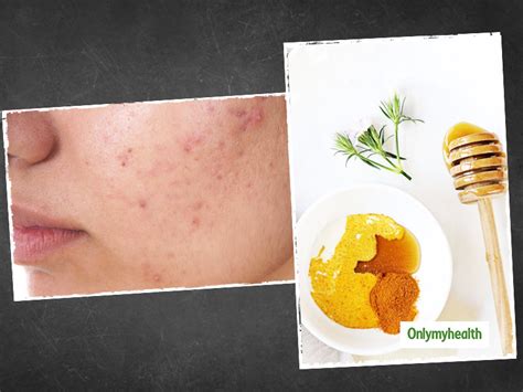Pimple Popping Up Types Causes And Treatment For These Tender Bumps