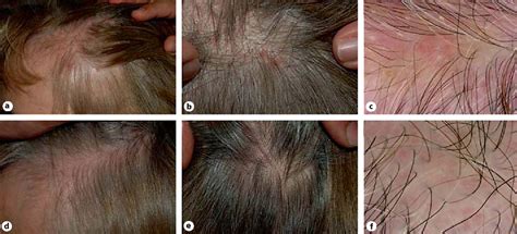 Figure 2 From Red Scalp Disease A Rosacea Like Dermatosis Of The