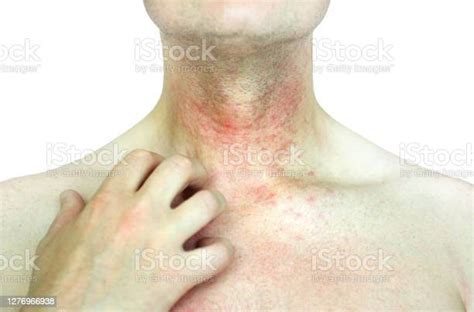 Atopic Dermatitis At Neck Stock Photo Download Image Now Istock