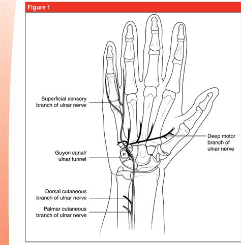 Figure 1 From Ulnar Tunnel Syndrome Radial Tunnel Syndrome Anterior