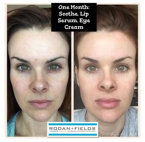 30 Days Using Soothe Regimen With The Lip Serum And Eye Cream Amazing