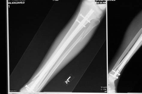 Tibfib Fracture X Rays Health And Fitness Thumpertalk