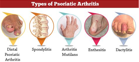 Psoriatic Arthritis Causes Symptoms Diagnosis Diet And Treatment