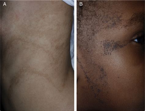 Blaschko Lines And Other Patterns Of Cutaneous Mosaicism Clinics In