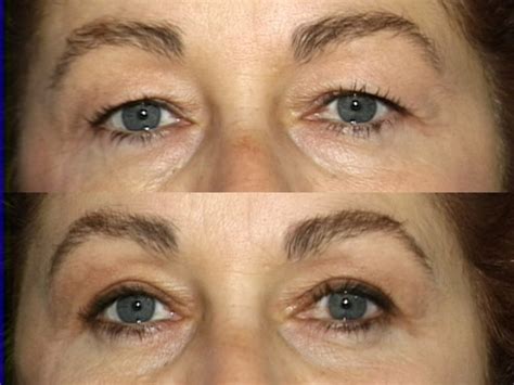 Before After Gallery Blepharoplasty Best Rhinoplasty And Nose Job