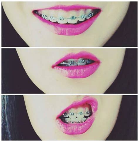 Braces Lips Nice Teeth And Vamp Image 253079 On