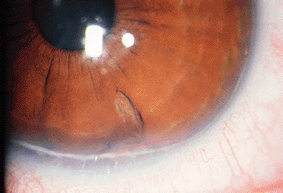 Er Can Be Mild Or Severe Alkali Tends To Penetrate The Cornea More