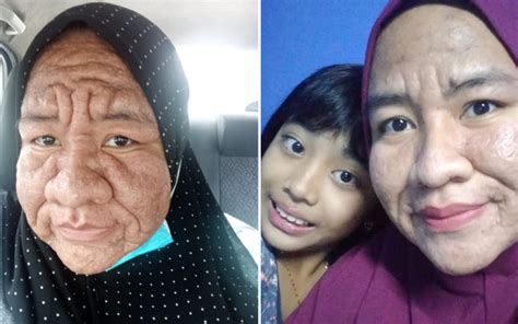Msian Woman Shares How Her Face Became Swollen And Heavily Wrinkled During Pregnancy Wau Post