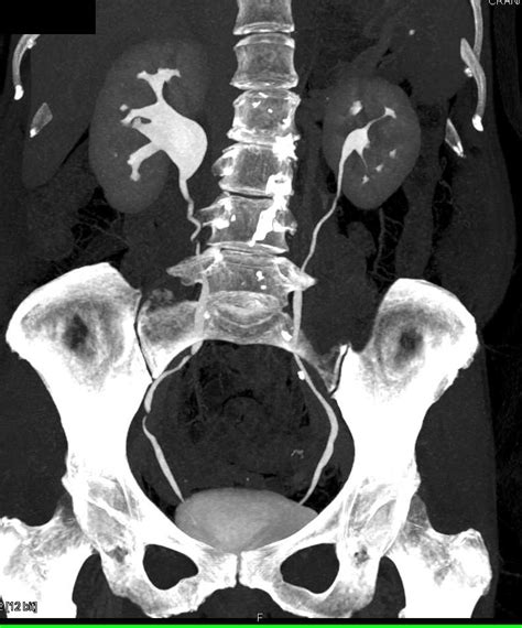 Ureteropelvic Junction Upj With Dilated Right Renal Pelvis Kidney