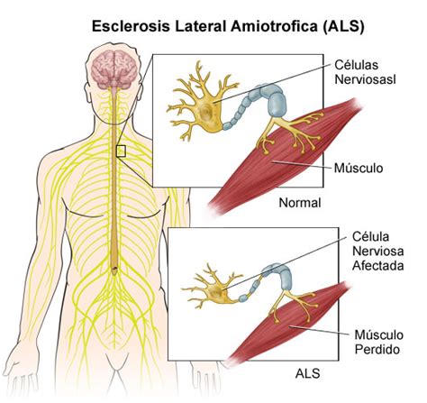 ¿qué es la esclerosis lateral amiotrófica? ESCLEROSIS LATERAL AMIOTRÓFICA: Una revisión de esa letal y gran desconocida - MasScience